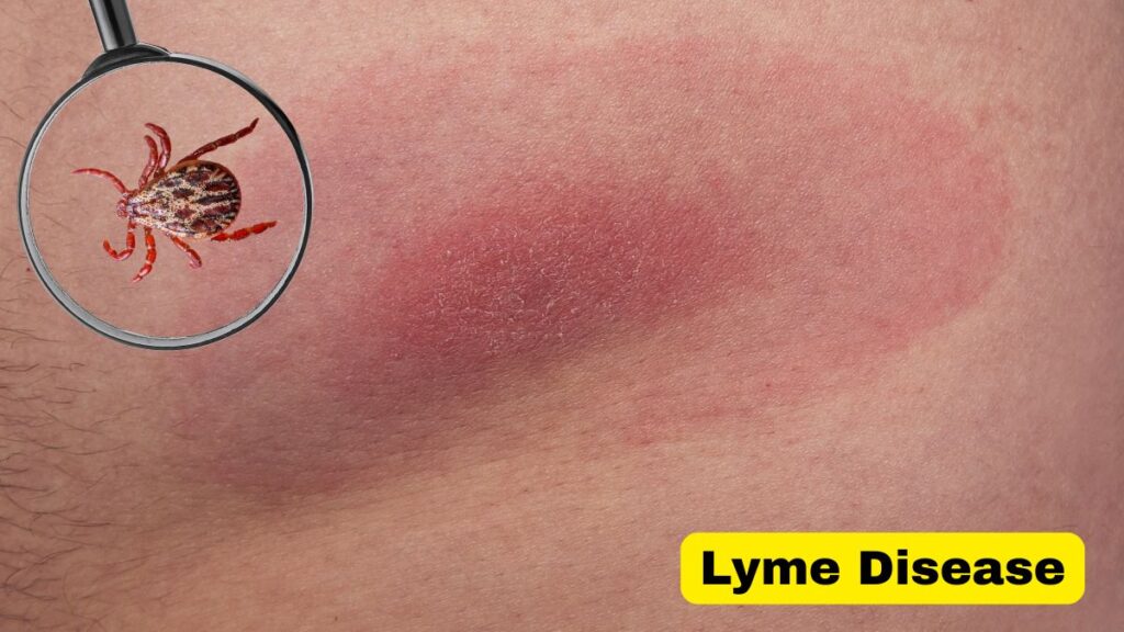 Lyme Disease