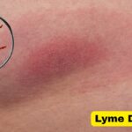 Lyme Disease