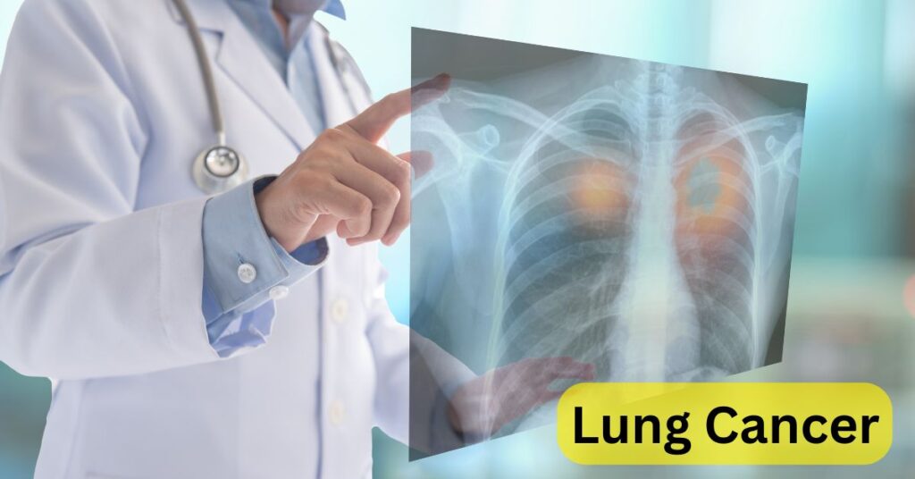 What are the first common signs of lung cancer