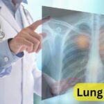 What are the first common signs of lung cancer