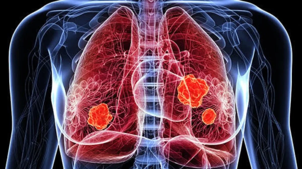 processed food lung cancer