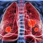 processed food lung cancer